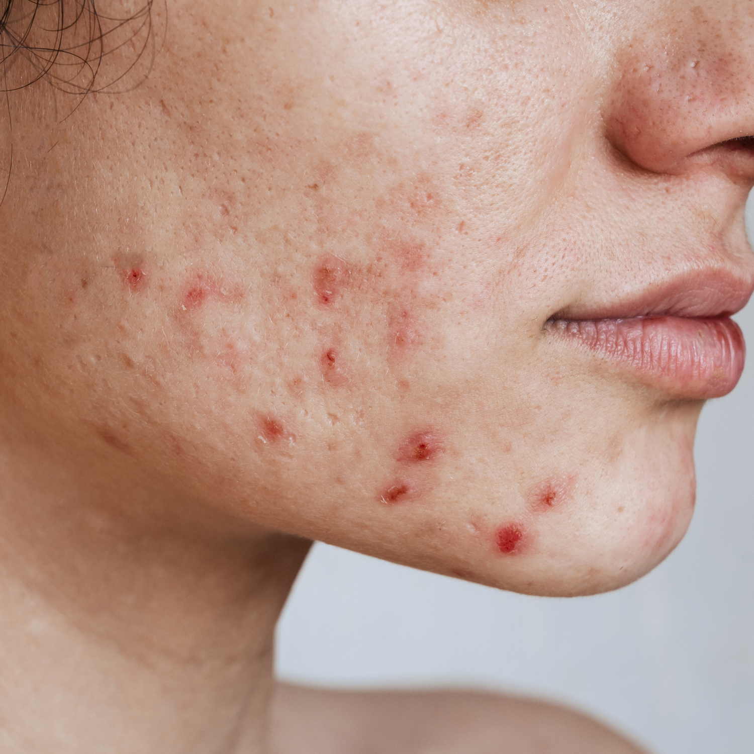 beauty-bar-winterhude-akne-pickel-glatte-haut