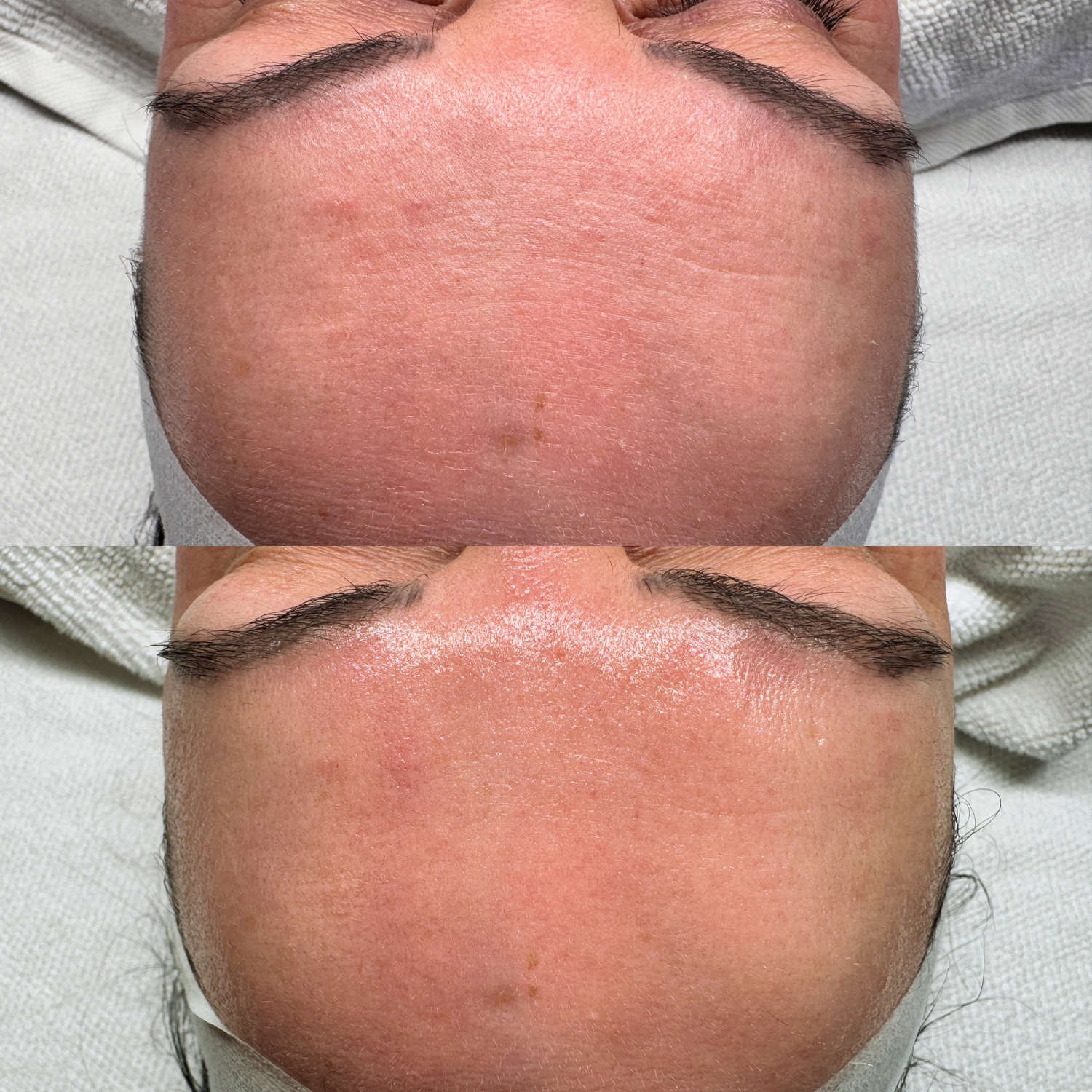 Beauty-bar-winterhude-ergebnis-hydrafacial-vorher-nachher
