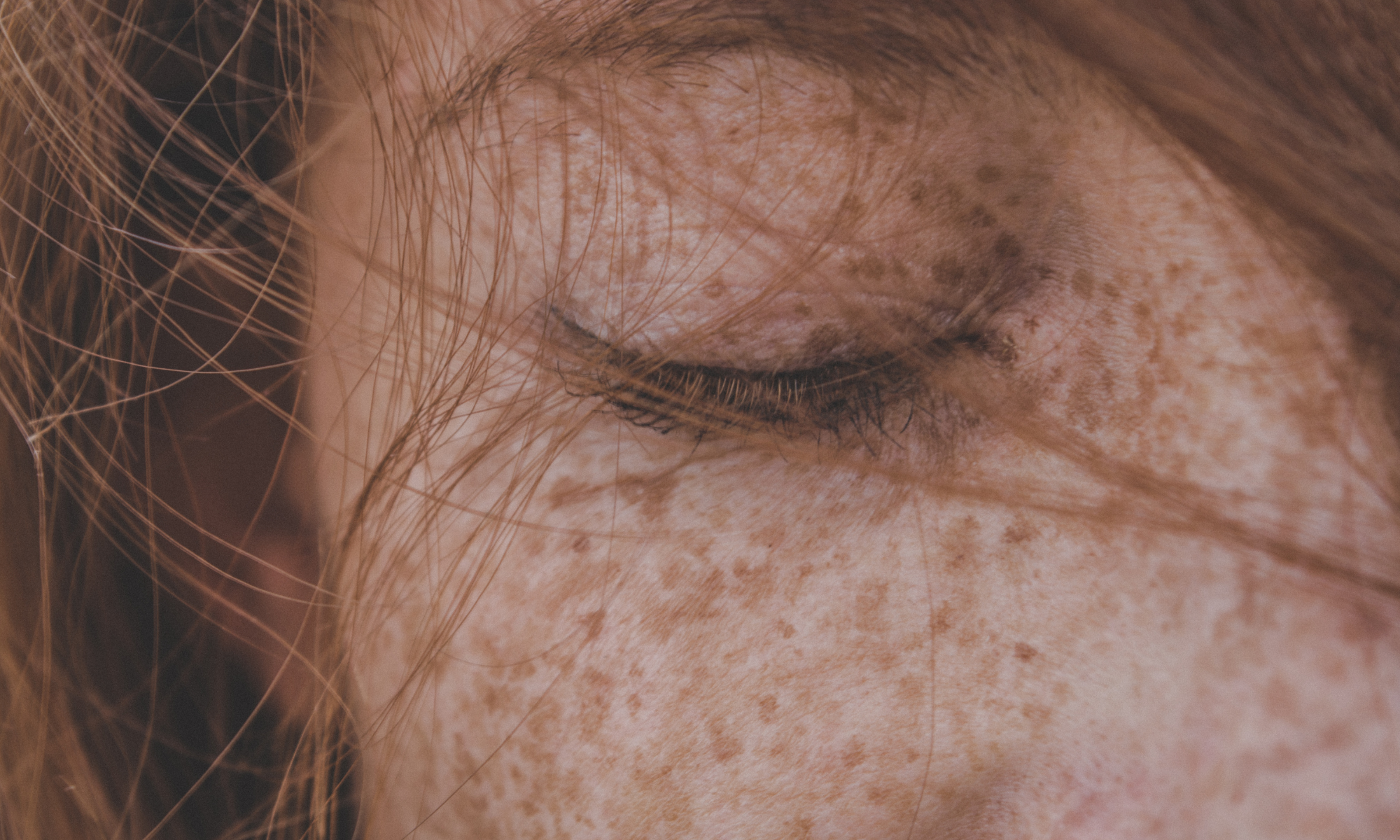 Beauty-bar-winterhude-radio-frequenzmicroneedling-Hautstraffung