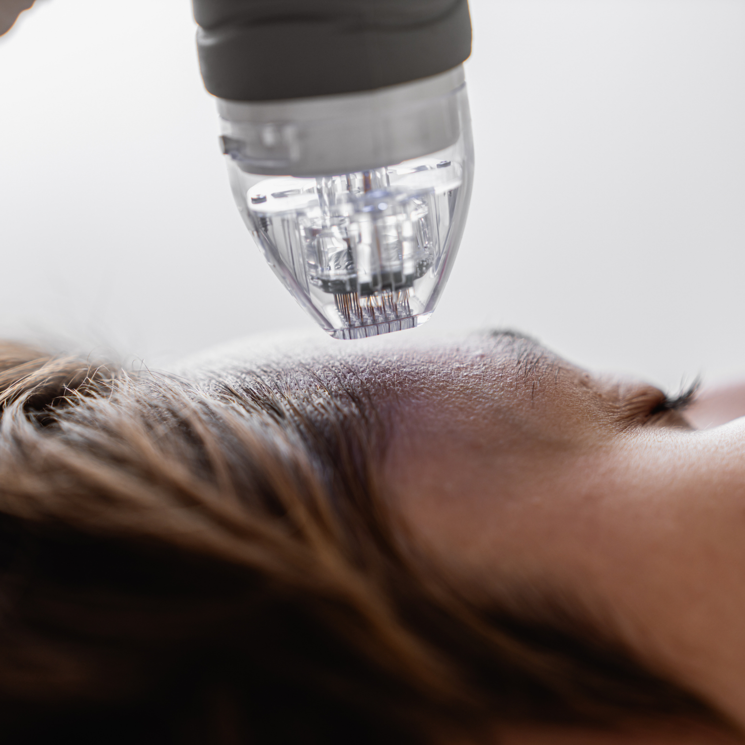 Beauty-ber-winterhude-radiofrequenz-needling-haut-glaettung